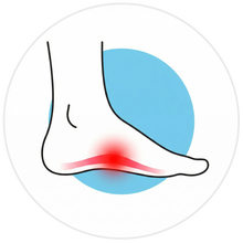 Plantar Fasciitis